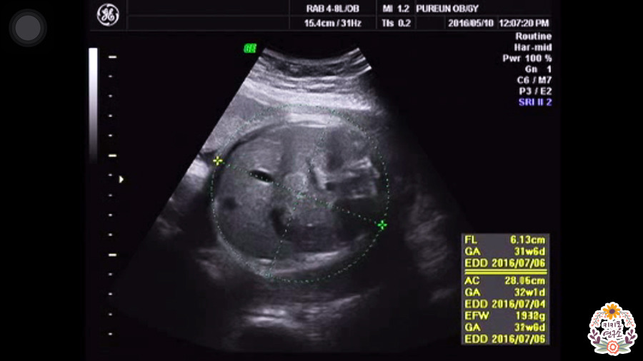 임신 32주 초음파 사진 용어 정리 - 키키몽 생활연구소